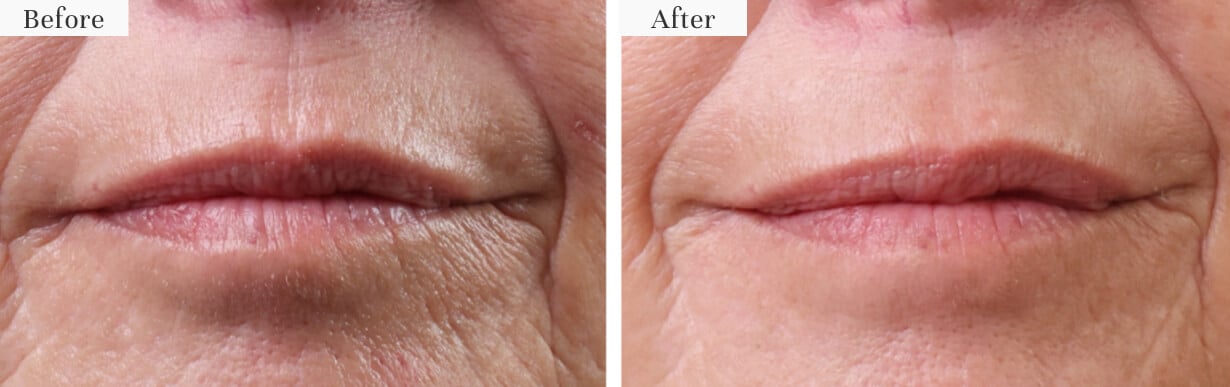 Before and after using Cherry Glam patches